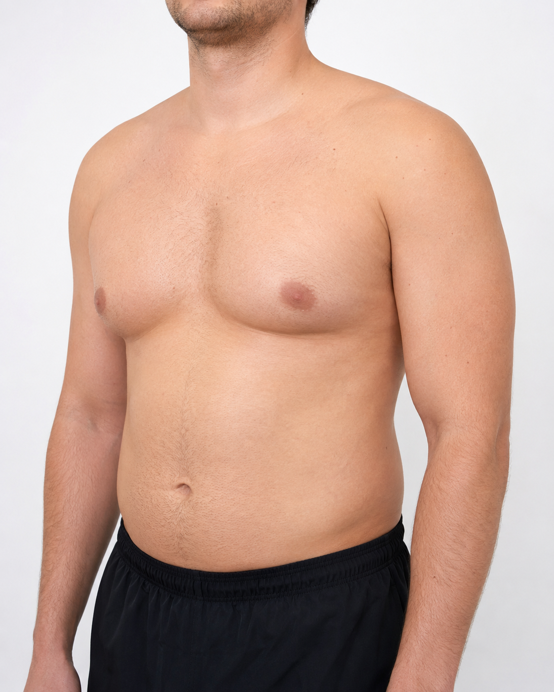 Before gynecomastia chest contouring